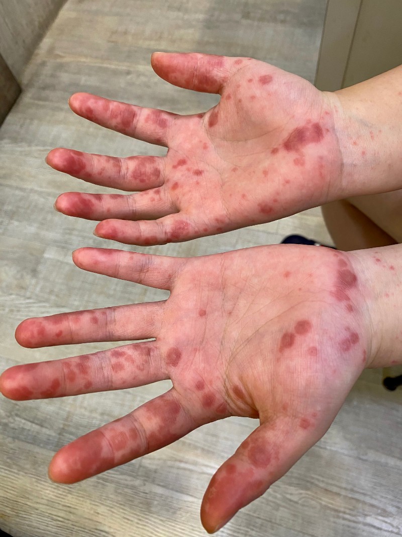 腸病毒不是小朋友的專利