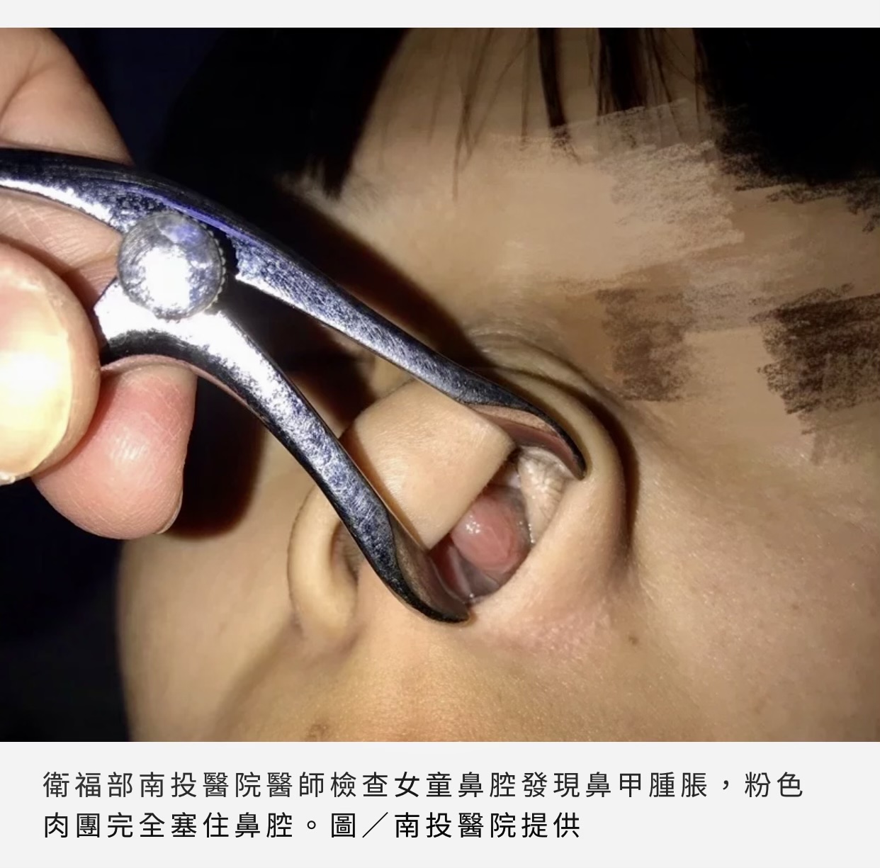 鼻噴劑亂用的可怕下場
